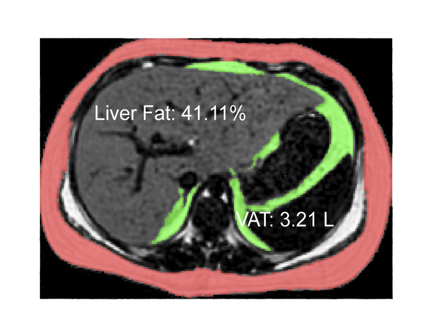 MRI Image of Fatty Liver in a Teenager
